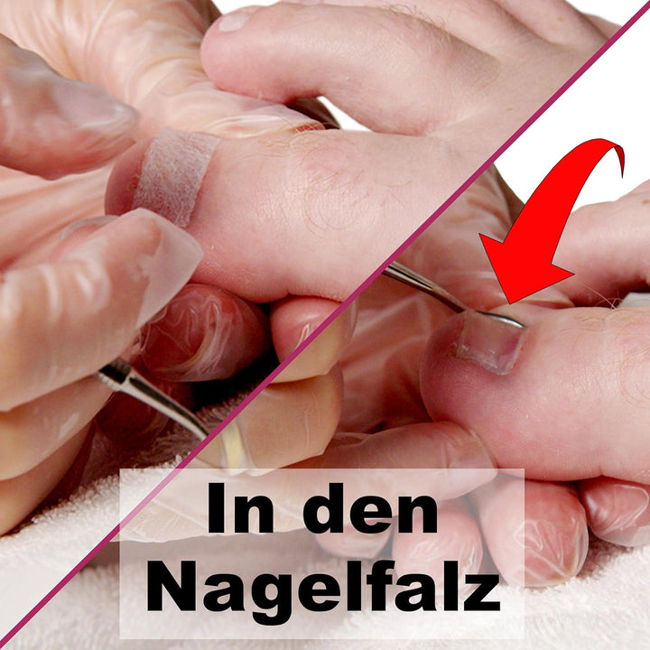 Kosmetex 2x Tamponade für den Nagelfalz 2x Zehenbinde als Schutz, Set 2 6 Stück (1er Pack), 6 St