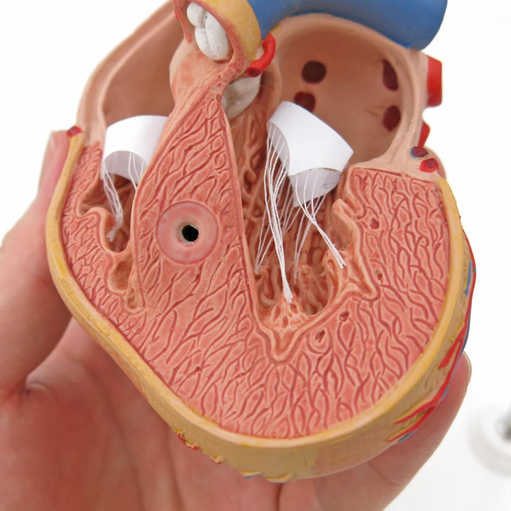 3B Scientific Menschliche Anatomie - Klassik-Herzmodell mit linksventrikulärer Hypertrophie (LVH), 2