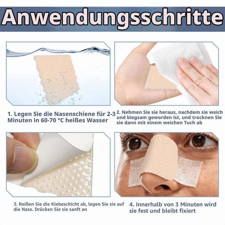 Thermoplastische Nasenschienen, externe Nasenstützung, Schutz für Nasenbandage, Rhinoplastie, Septop