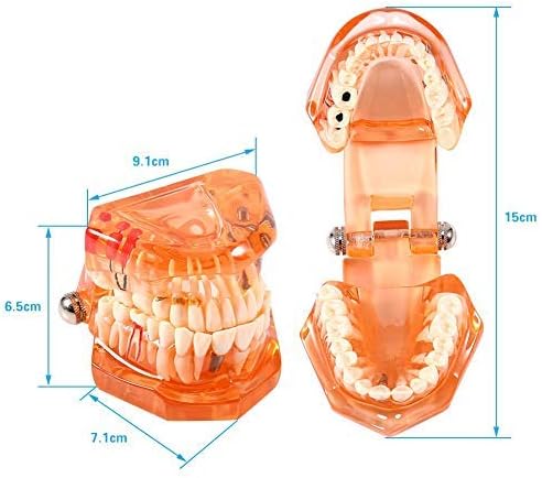 Jadeshay Zahnmodell Dentalmodell, Entfernbares Zahn-Implantat Lehrmodell Zahnarzt Demonstration Werk