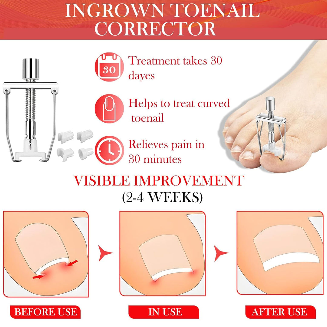 Ingrown Toenail Treatment, ELALRAU Ingrown Toenail Removal Kit with Ingrown Toenail Corrector Drops,