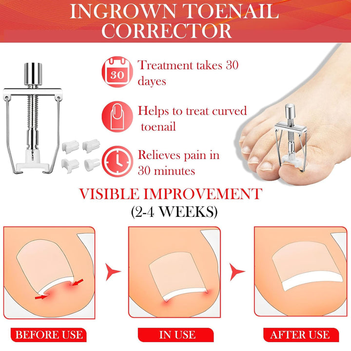 Ingrown Toenail Treatment, ELALRAU Ingrown Toenail Removal Kit with Ingrown Toenail Corrector Drops,