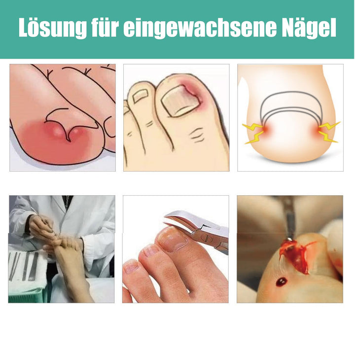 1 Satz Eingewachsene Zehennagel-Werkzeuge, Nagel-Korrekturschnalle, Patch Gebogene Zehennägel Klamme