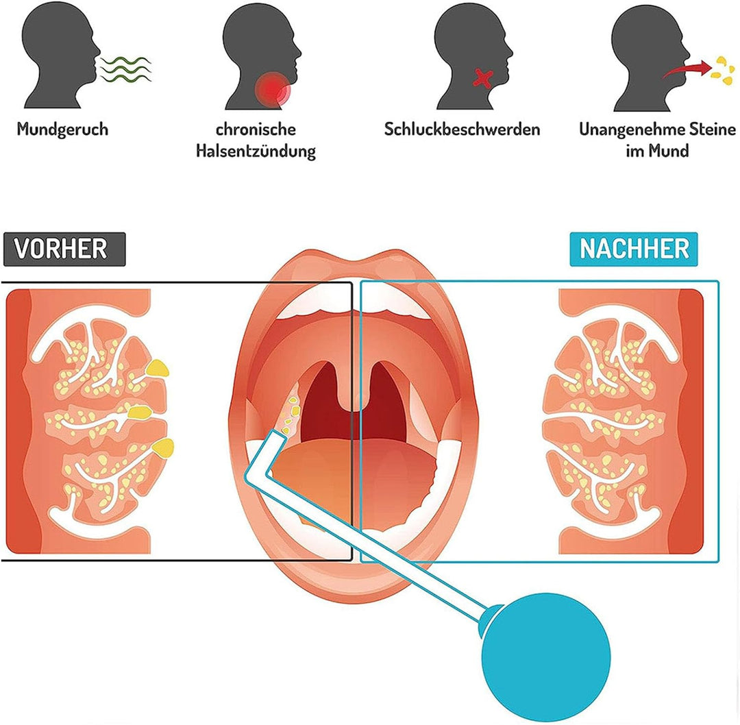 Tonsillenstein-Entfernungsset, Tonsillenstein-Entferner, Vakuum-Mandelstein-Schröpfwerkzeug, PVC-Sau