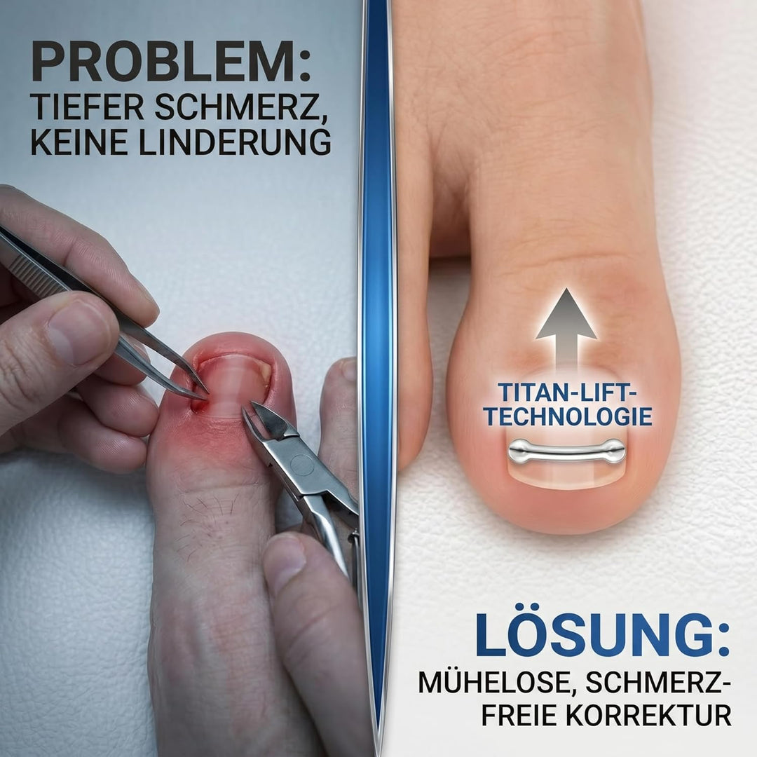 Eingewachsene Zehennägel Set, Zehennägel Korrektur Patch, Nagelspange Fussnägel, Entwickelt für Eing