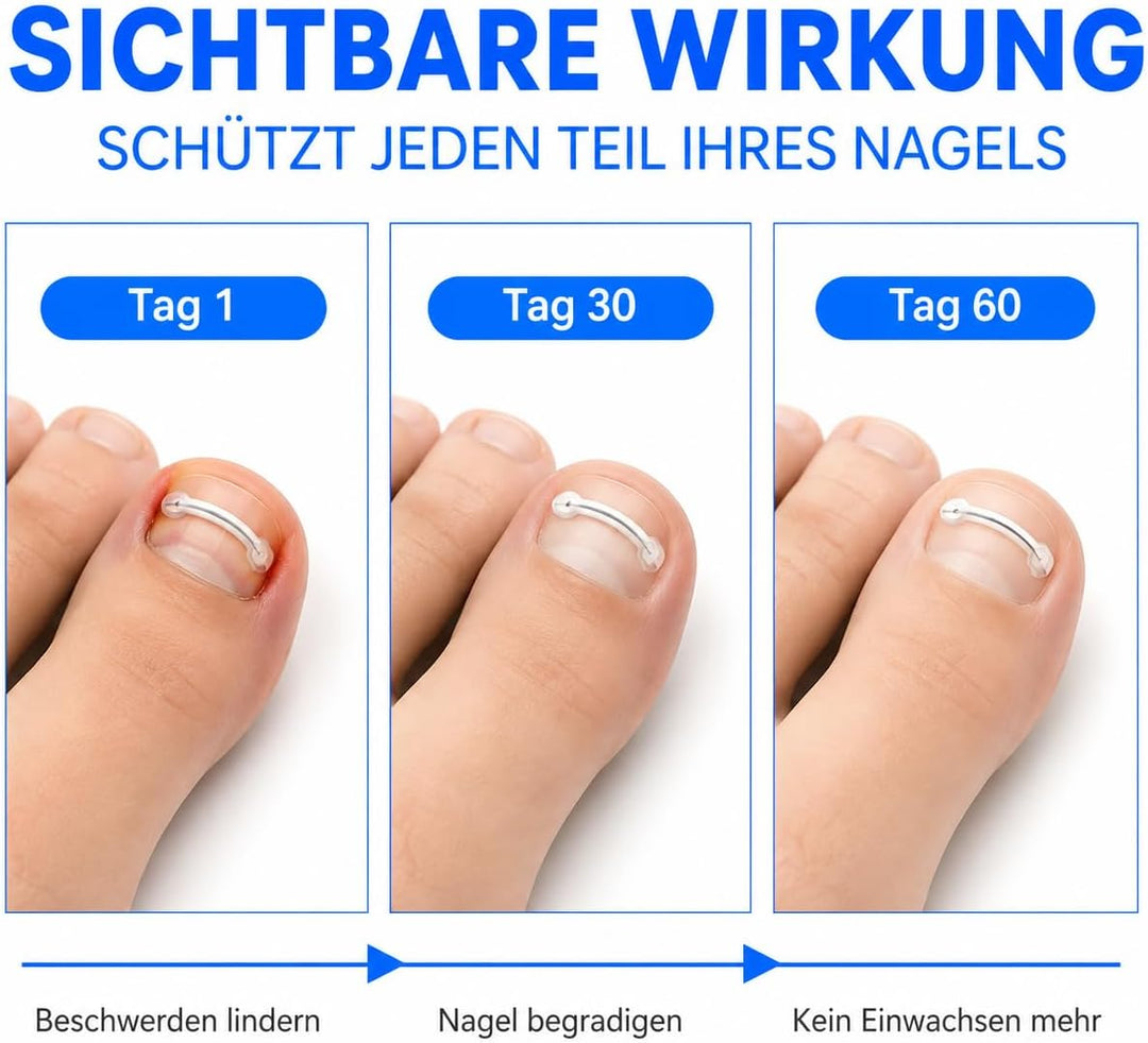 Eingewachsene Zehennägel Set, Universal Nagelspange Fussnägel Korrektu | Fünf Verschiedene Grössen,