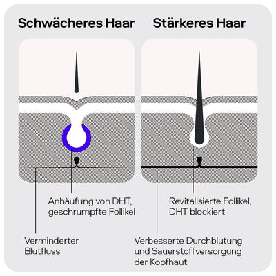 Sons Minoxidil 5% Lösung zur äusseren Anwendung, Haarwuchs & Verdichtung, Bei Haarausfall & lichtem