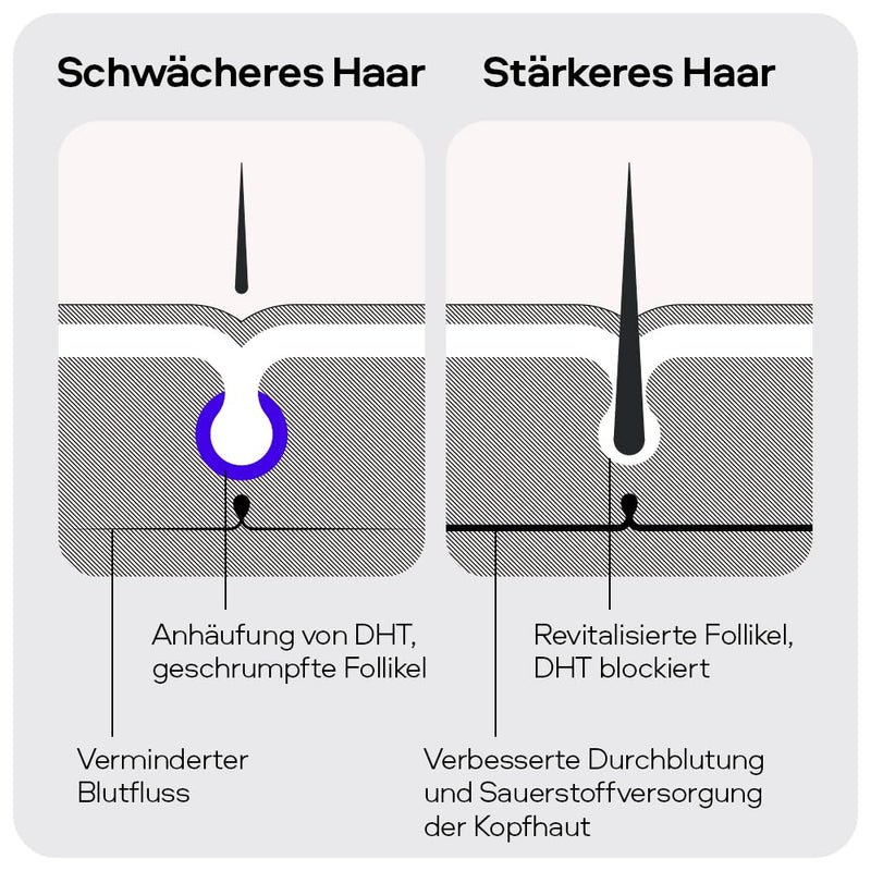 Sons Minoxidil 5% Lösung zur äusseren Anwendung, Haarwuchs & Verdichtung, Bei Haarausfall & lichtem