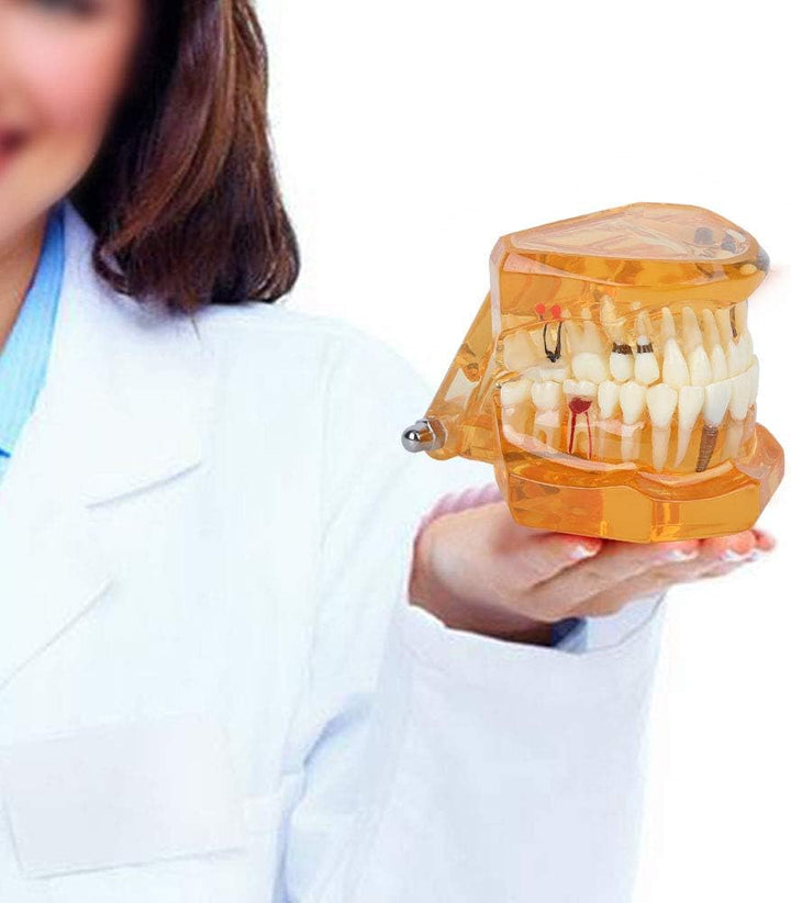 Zahnmodell Zahnkrankheits-Lehrmodell Abnehmbares Implantat Zahnmodell Mundmodell für Erwachsene für