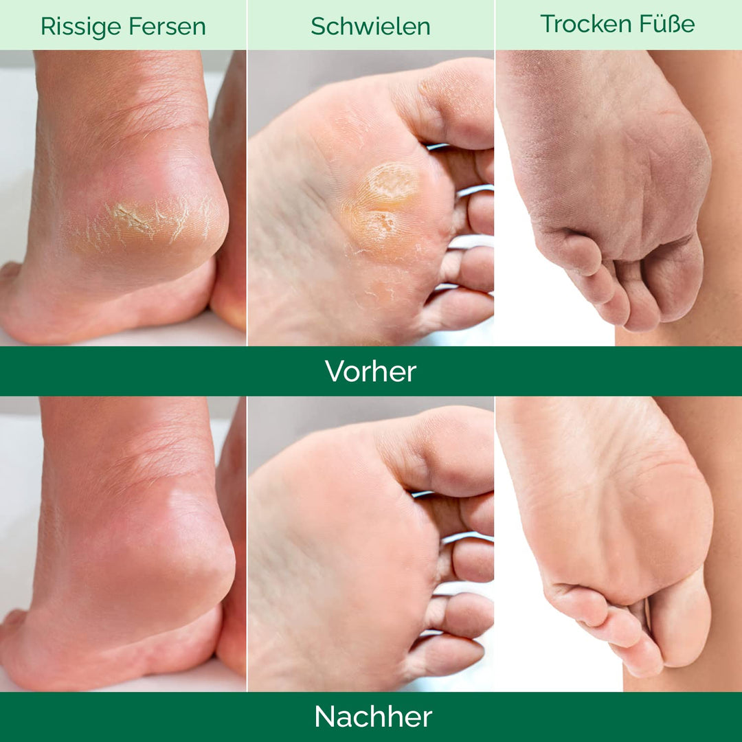 Plantifique Fussmaske - 2 Paar Hornhaut Socken für Männer - Fussmaske Hornhautentferner Socken - Hor