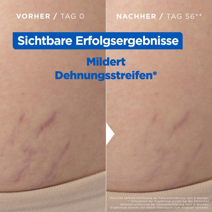 Mixa Stretch Mark Oil, Anti-Dehnungsstreifen Öl, Mildert das Erscheinungsbild & den Juckreiz von Deh