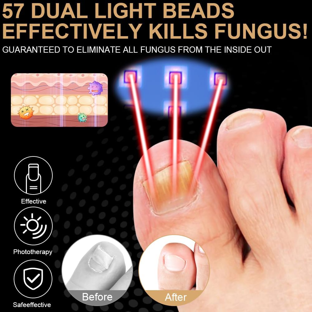 AOOWU Nagelpilz Laser Gerät, Nagelpilz-Laser, Gerät zur Reinigung und Pflege der Nägel für Zehennage