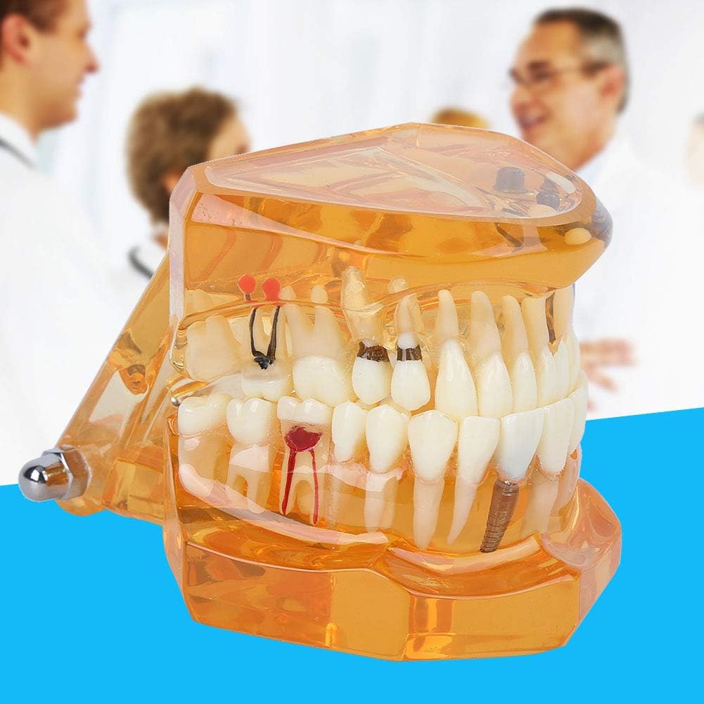 Natudeco Zahnärztliche Studienmodell untersuchen Modell Dental Maxillary Overdenture Model Minderwer