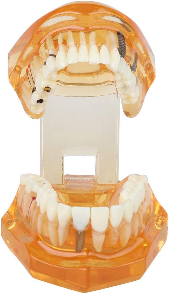 Natudeco Zahnärztliche Studienmodell untersuchen Modell Dental Maxillary Overdenture Model Minderwer