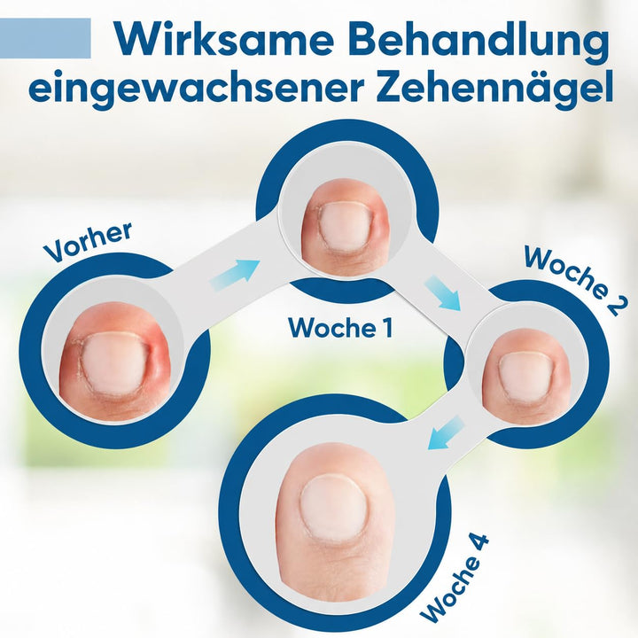 Eingewachsene ZehennäGel Tropfen, Korrekturtropfen | FüR Eingewachsene ZehennäGel, Schnell Wirkende