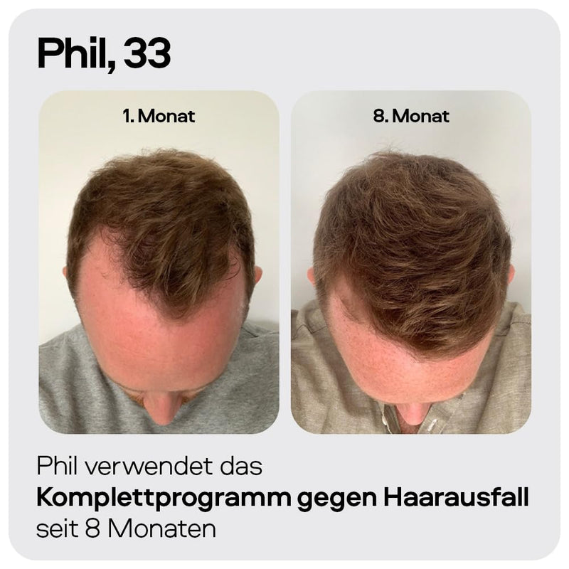 Sons Minoxidil 5% Lösung zur äusseren Anwendung, Haarwuchs & Verdichtung, Bei Haarausfall & lichtem