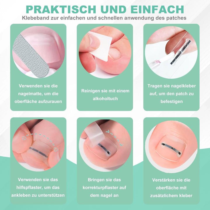 Eingewachsene Zehennägel Set Zehennagel Korrektur Patch 9pcs Nagelspange Fussnägel Zehennagelheber W