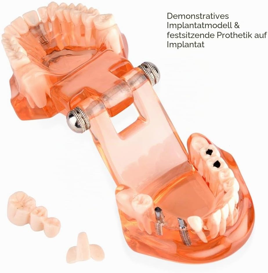 Jadeshay Zahnmodell Dentalmodell, Entfernbares Zahn-Implantat Lehrmodell Zahnarzt Demonstration Werk