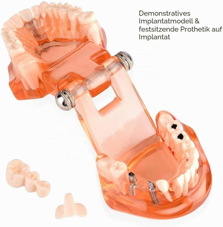 Jadeshay Zahnmodell Dentalmodell, Entfernbares Zahn-Implantat Lehrmodell Zahnarzt Demonstration Werk