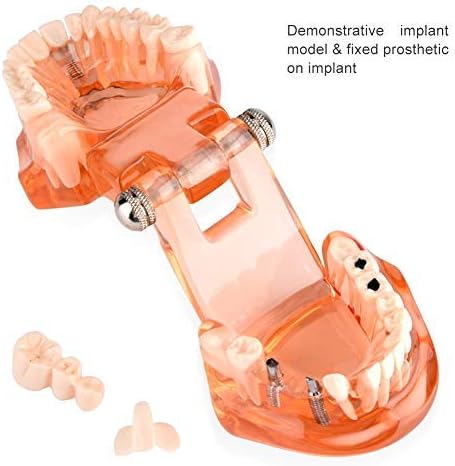 Jadeshay Zahnmodell Dentalmodell, Entfernbares Zahn-Implantat Lehrmodell Zahnarzt Demonstration Werk