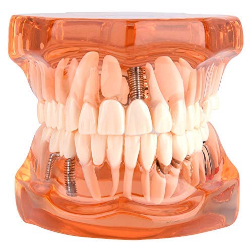 Jadeshay Zahnmodell Dentalmodell, Entfernbares Zahn-Implantat Lehrmodell Zahnarzt Demonstration Werk