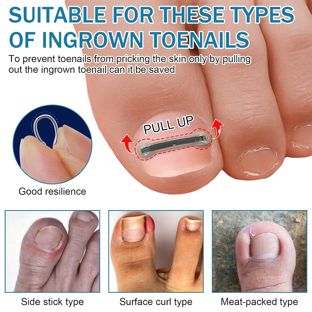 Eingewachsene Zehennägel Set, Zehennägel Korrektur Patch, Nagelspange Fussnägel Eingewachsener Zehna