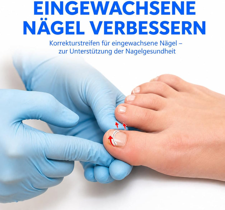 Eingewachsene Zehennägel Set, Universal Nagelspange Fussnägel Korrektu | Fünf Verschiedene Grössen,