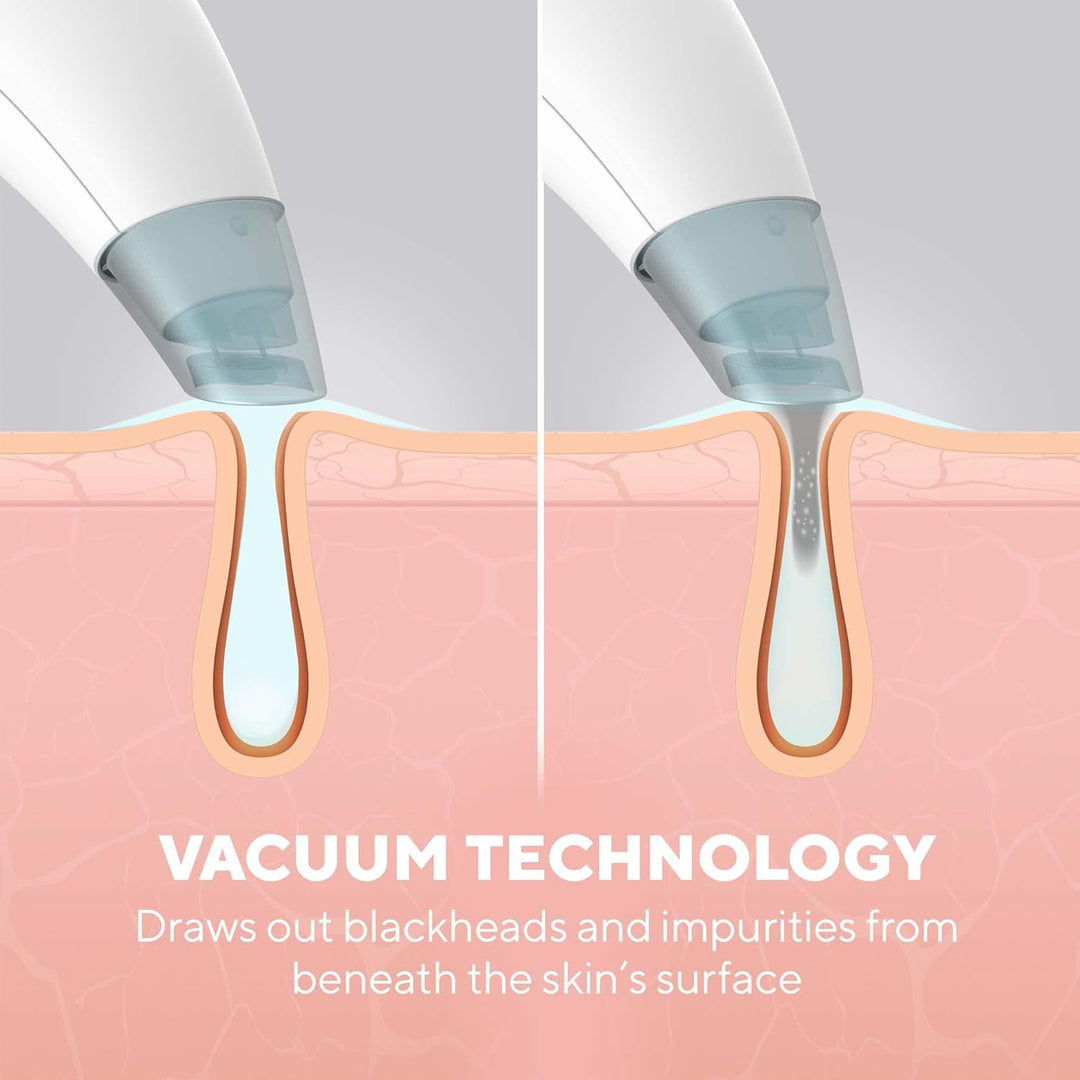 HoMedics Refresh Hydradermabrasion Cleanser - Mitesser-Entferner & Akne-Behandlung Werkzeug, Vakuum-