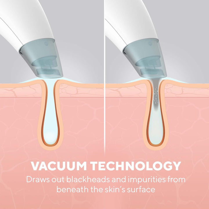 HoMedics Refresh Hydradermabrasion Cleanser - Mitesser-Entferner & Akne-Behandlung Werkzeug, Vakuum-