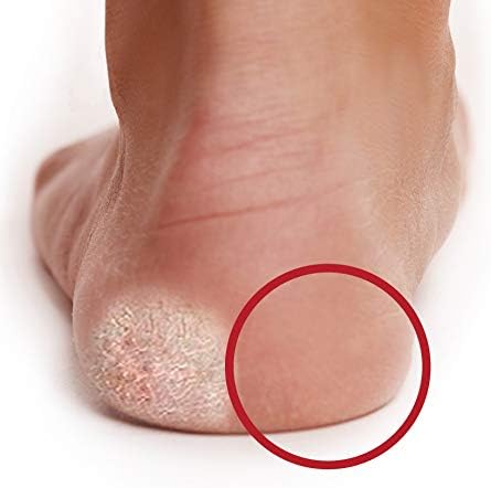 Peter Bausch 0328 - Aufladbares Hornhautschleifgerät EasyPedipeel mit ergonomischem Griff zum Entfer
