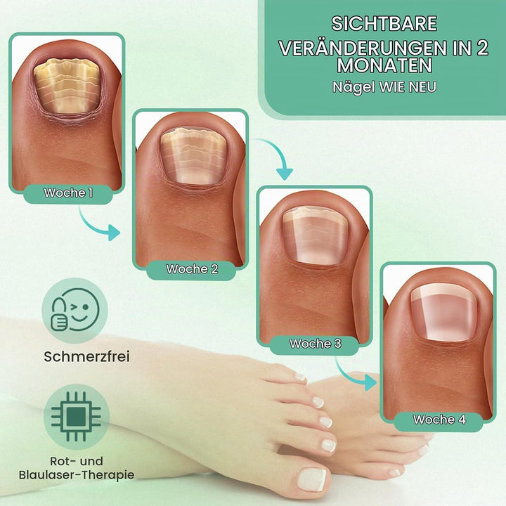 iKeener Kabellose Nagelpilz Lasergerät,FDA Zulassung Nagel Reinigung Fingernägel &amp; Onychomykose,15*4