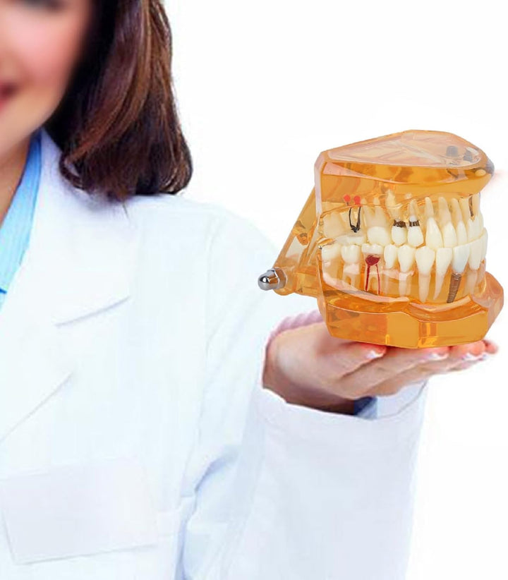 Natudeco Zahnärztliche Studienmodell untersuchen Modell Dental Maxillary Overdenture Model Minderwer