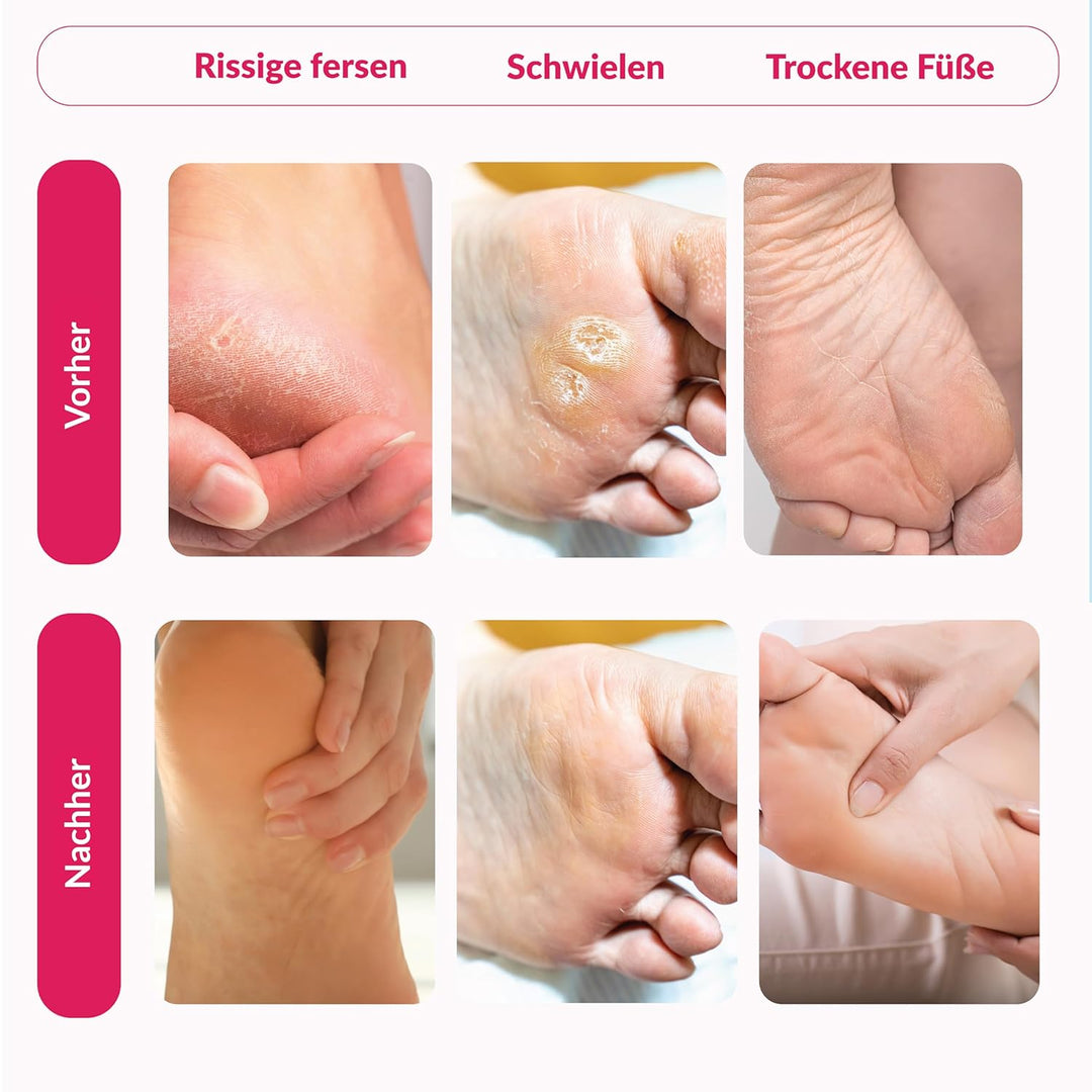 Summer Foot Premium Hornhaut-Entferner - Hornhaut Fussmaske für weiche Füsse - Anti Hornhaut-Socken