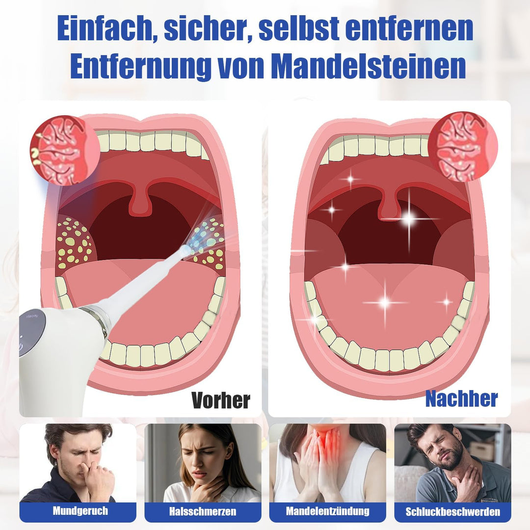 Mandelsteinentferner Set 3-in-1, Einfaches Tonsillenstein Entfernen + 32 Mundreinigungsfingerhandsch