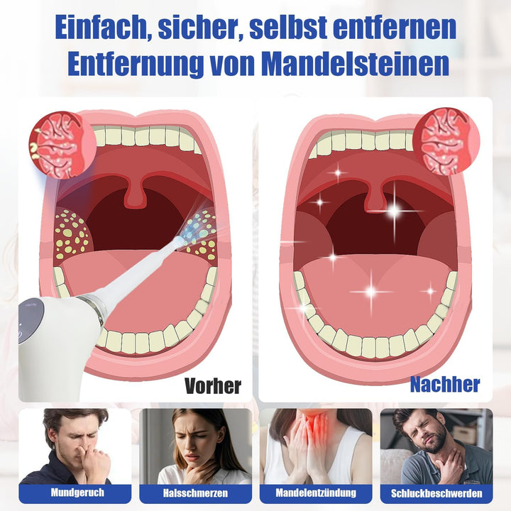 Mandelsteinentferner Set 3-in-1, Einfaches Tonsillenstein Entfernen + 32 Mundreinigungsfingerhandsch