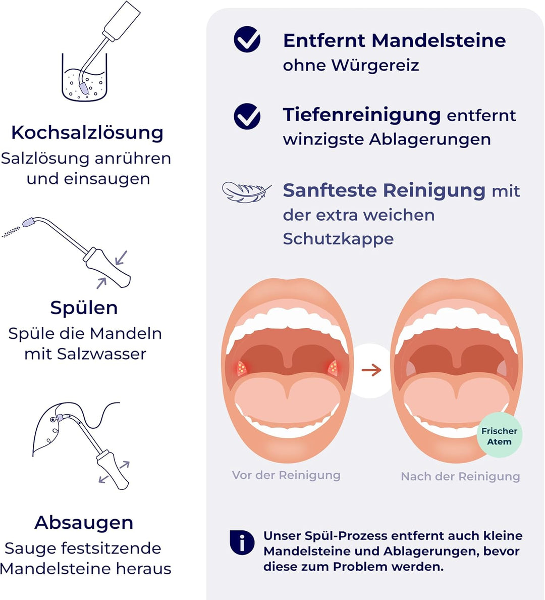 TONSI 2in1 Mandelstein Schröpfglas & Munddusche | Mandelstein Entferner Made in Germany | Mandeln sp