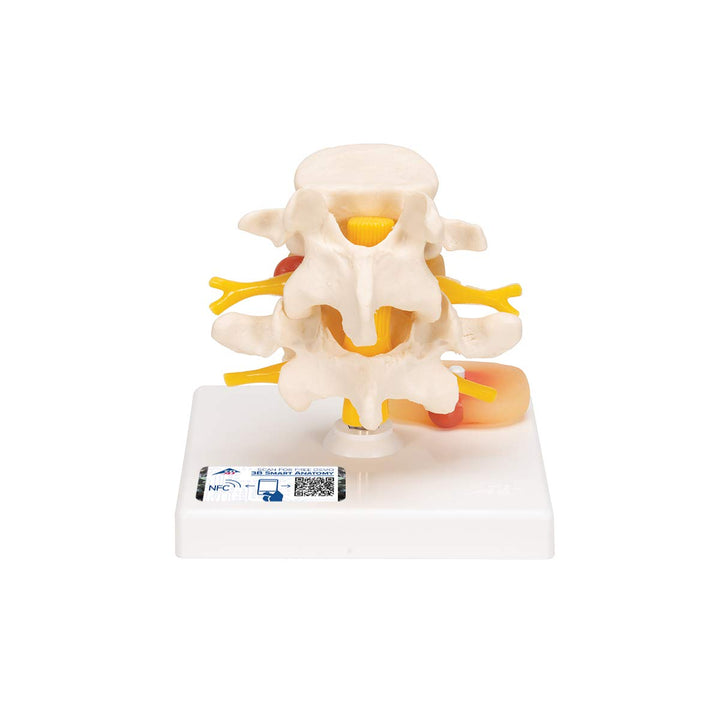 3B Scientific 3B Smart Anatomy Lendenwirbelsäule mit Bandscheibenvorfall + kostenlose Anatomie App -