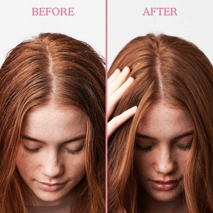 Umberto Giannini Scalp Restore Conditioner 250ml Anti-Schuppen Conditioner, 250 ml, Anti-Schuppen Co