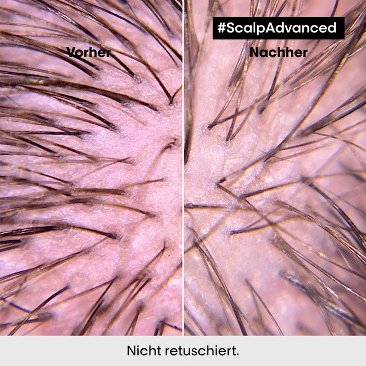 L'Oréal Professionnel Pflegeset zur Beruhigung sensibler Kopfhaut, Scalp Advanced, Anti-Discomfort D