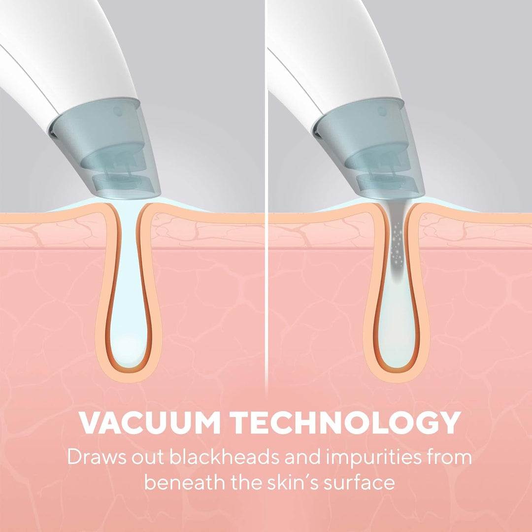 HoMedics Refresh Hydradermabrasion Cleanser - Mitesser-Entferner & Akne-Behandlung Werkzeug, Vakuum-