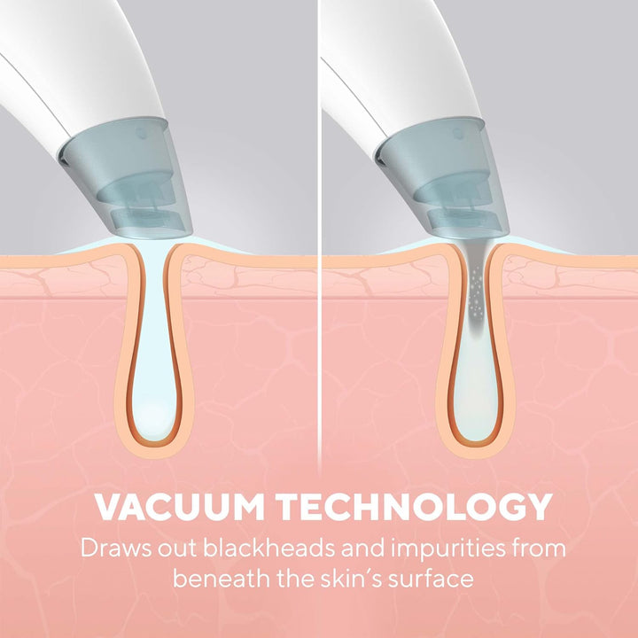 HoMedics Refresh Hydradermabrasion Cleanser - Mitesser-Entferner & Akne-Behandlung Werkzeug, Vakuum-