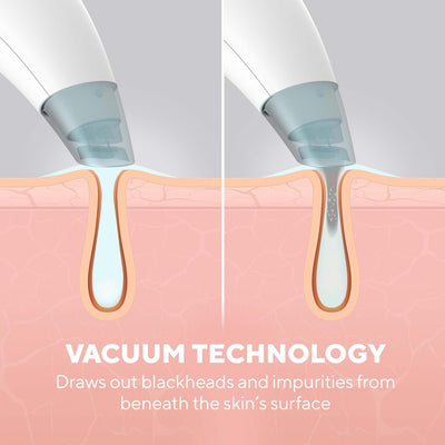 HoMedics Refresh Hydradermabrasion Cleanser - Mitesser-Entferner & Akne-Behandlung Werkzeug, Vakuum-