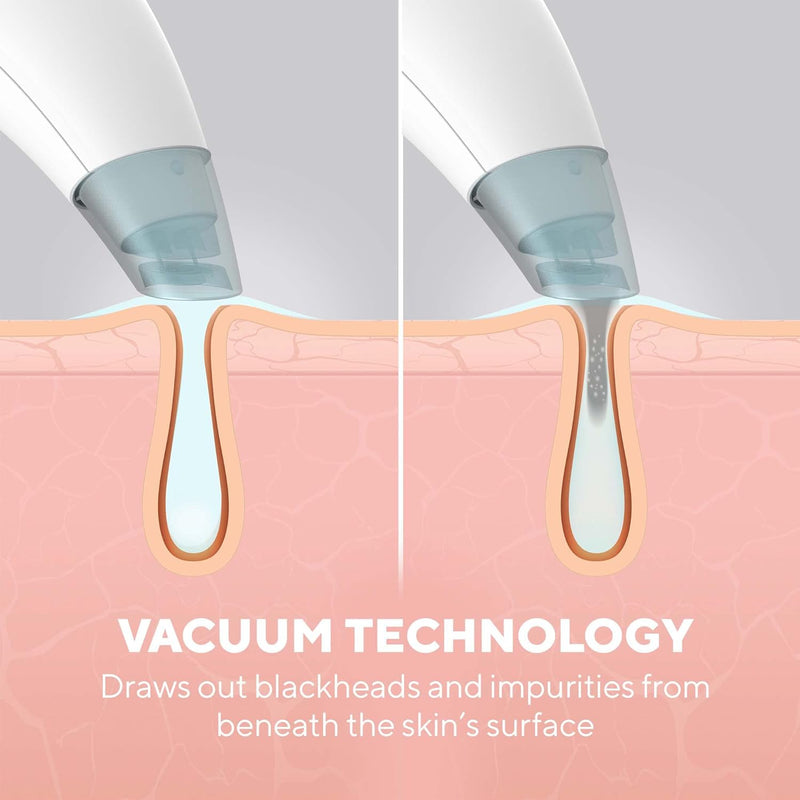 HoMedics Refresh Hydradermabrasion Cleanser - Mitesser-Entferner & Akne-Behandlung Werkzeug, Vakuum-