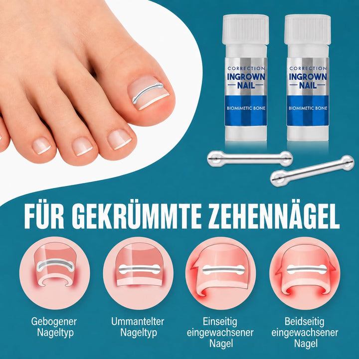 Eingewachsene Zehennägel Set, Zehennagel Korrektur,5 verschiedene Grössen 1 stück (1er Pack), 1 stüc