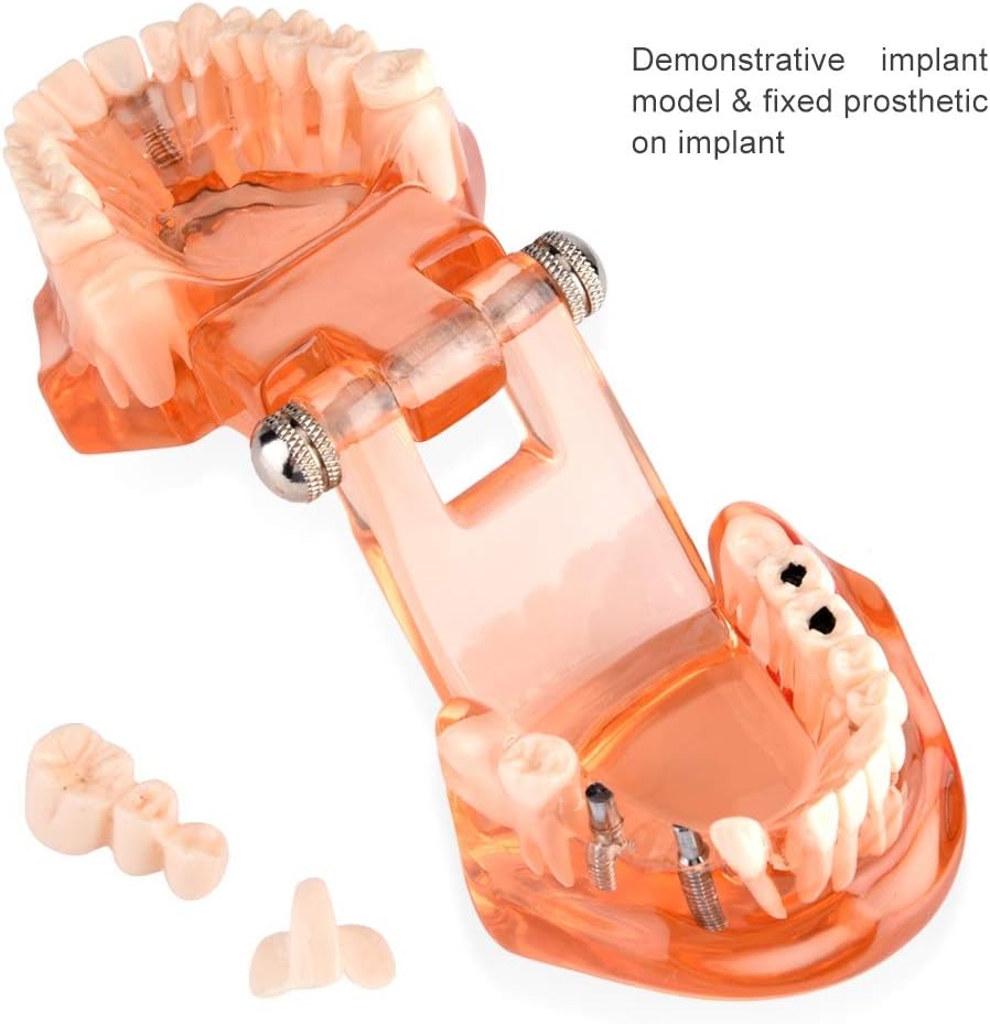 Jadeshay Zahnmodell Dentalmodell, Entfernbares Zahn-Implantat Lehrmodell Zahnarzt Demonstration Werk