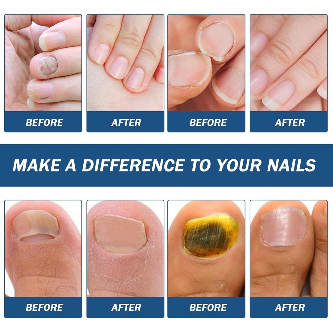 42 Stück Nail Patches For Toenails & Fingernails,Mehrzweck Zehennagel Pads