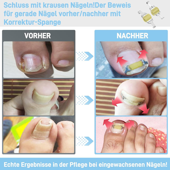 InhwRior Eingewachsene-Nagel-Korrektor–Einfache Anwendung für zu Hause, sicherer Halt (rutscht nicht