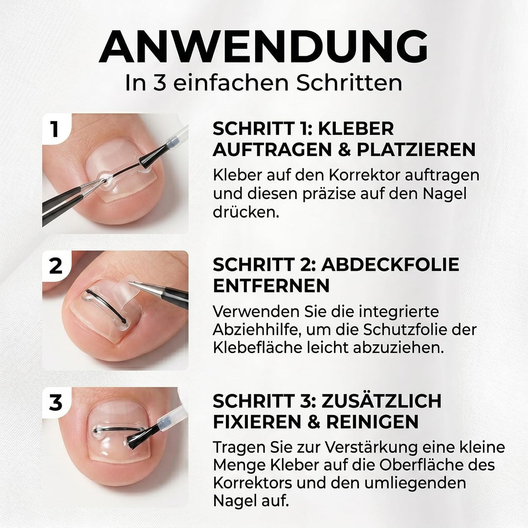 Eingewachsene Zehennägel Set, Zehennägel Korrektur Patch, Nagelspange Fussnägel, Entwickelt für Eing