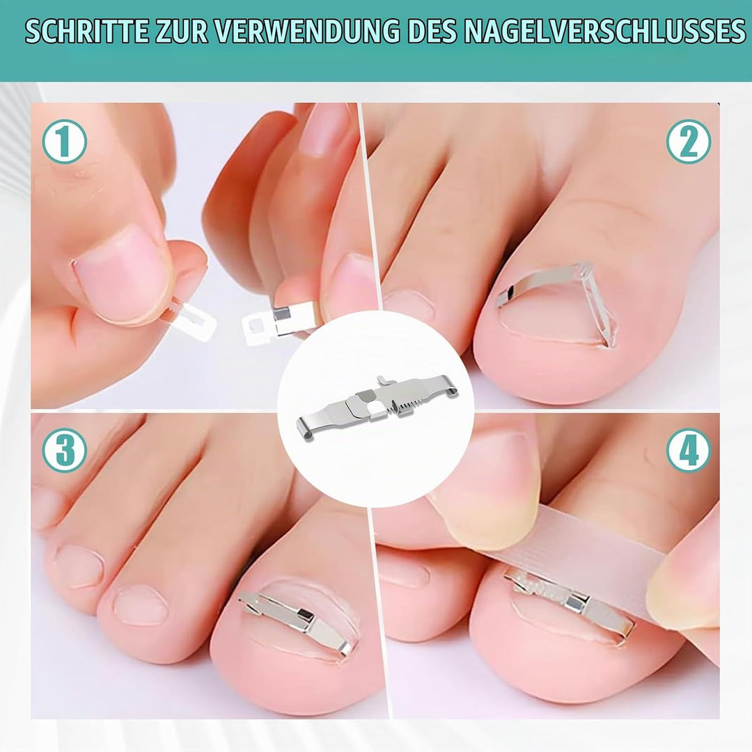 152 Pcs Nagelspange FussNäGel,Eingewachsene ZehennäGel Set,Zehennagel Eingewachsen,Nagelspange FussN