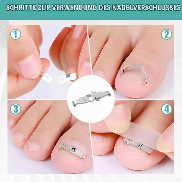 152 Pcs Nagelspange FussNäGel,Eingewachsene ZehennäGel Set,Zehennagel Eingewachsen,Nagelspange FussN